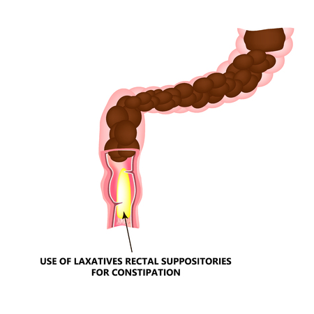 Use of laxatives rectal suppositories for constipation. Feces in colon. Infographics. Vector illustration on isolated background.のイラスト素材