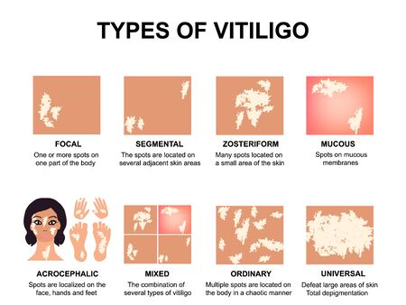 Types of vitiligo. World Vitiligo Day. Infographics. Vector illustration on isolated backgroundのイラスト素材