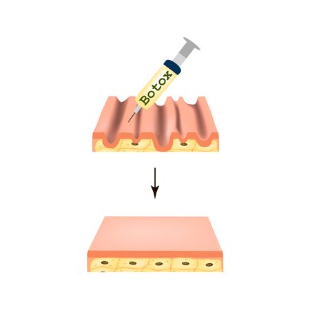 Wrinkles on the skin. Botox wrinkle treatment. Anatomical skin structure. Botox injection. Infographics. Vector illustration on isolated background.のイラスト素材