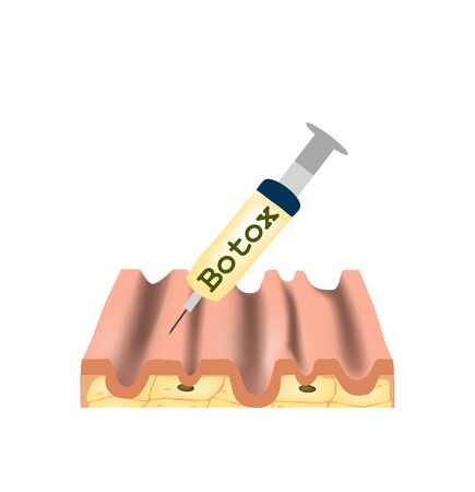 Wrinkles on the skin. Botox wrinkle treatment. Anatomical skin structure. Botox injection. Infographics. Vector illustration on isolated background.のイラスト素材