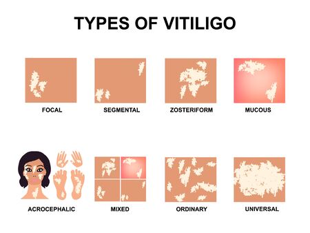 Types of vitiligo. World Vitiligo Day. Infographics. Vector illustration on isolated background.のイラスト素材