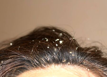 Dandruff on the hair. Hair disease seborrhea. Fatty Dandruff.の写真素材