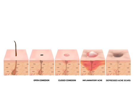 Treatment of open comedones, inflamed acne, acne cysts. Sore acne. structure of the skin. Treatment of scars of acne and pimples. blackheads. Infographics. Vector illustration on isolated backgroundのイラスト素材