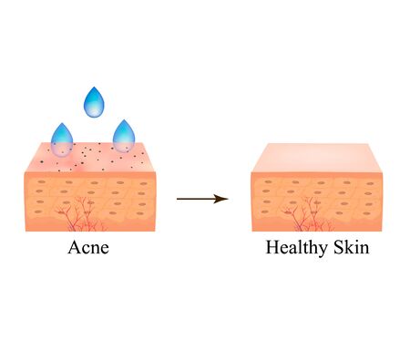 Acne treatment with acid peeling. Black spots of blackheads on the skin. Acne black. Pore cleansing. The anatomical structure of the skin with acne. Vector illustration on isolated backgroundのイラスト素材