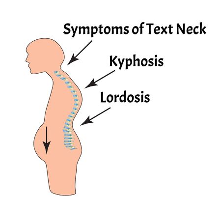 The position of the spine with lordosis, kyphosis. Text Neck Syndrome. Spinal curvature, kyphosis, lordosis, scoliosis, arthrosis. Poor posture and slouching. Infographics. Vector illustration.のイラスト素材