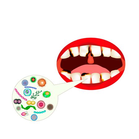 caries. Smell from the mouth. Halitosis. The structure of the teeth and oral cavity. Diseases of the teeth caries. Infographics. Vector illustration on isolated background.のイラスト素材