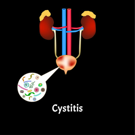 Cystitis. Inflammation of the bladder. The structure of the kidneys and bladder. Excretory system....
