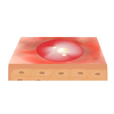 Cyst acne. furuncle Acne on the skin cysts and pimples. Dermatological and cosmetic inflammatory diseases on the skin of the face. Infographics. Vector illustration on isolated backgroundのイラスト素材