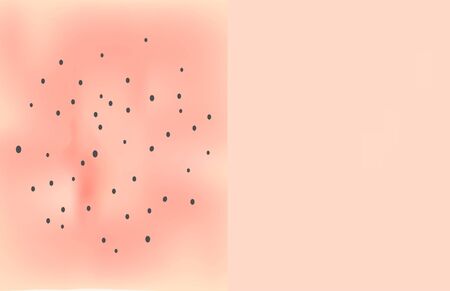 Skin texture with black dots of acne. Before After acne. Skin background. Infographics. Vector illustrationのイラスト素材
