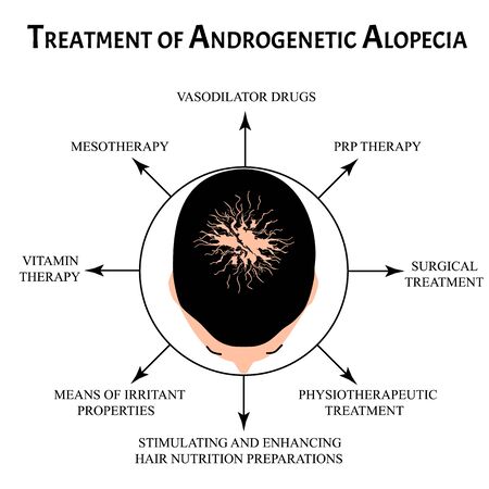 Treatment of alopecia. Bald spot, baldness, Alopecia mesotherapy. Infographics. Vector illustration on isolated background.のイラスト素材