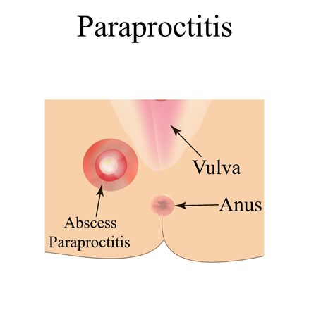 Paraproctitis. Abscess in the perineum. Inflammation paraproctitis. Infographics. Vector illustration on isolated background.のイラスト素材
