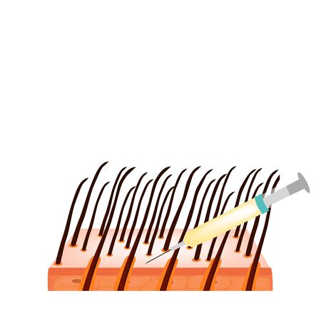 Treatment of alopecia. Bald spot, baldness, Alopecia mesotherapy. Infographics. Vector illustration on isolated background.のイラスト素材