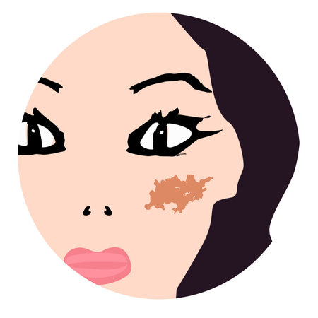 Pigmentation on the skin. A pigmented spot on the skin of the face. Vector illustration.のイラスト素材