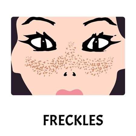 Freckles on the face. Pigmentation on the skin. A pigmented spot on the skin of the face. Vector illustration.のイラスト素材