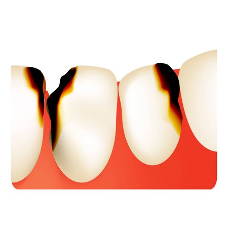 Dental caries. tooth decay. Caries infographics. Vector illustration on isolated backgroundのイラスト素材