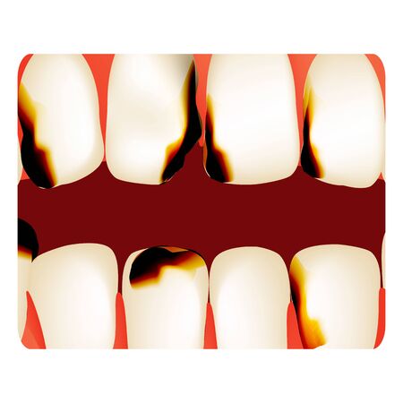 Dental caries. tooth decay. Caries infographics. Vector illustration on isolated backgroundのイラスト素材