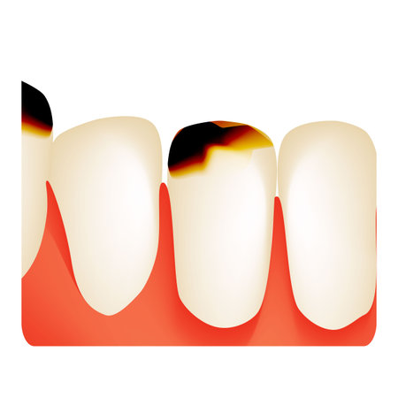 Vector of Dental caries. tooth decay. - ID:1-146577259 - Royalty Free ...
