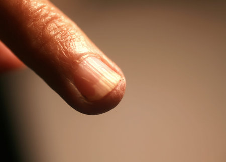 Fungal infection under the nail. A finger on a hand with a fungal infection of the nail.