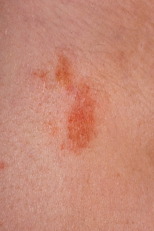 The great red spot on the skin closeup