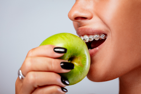 Close-up of a smiling girl face with braces on white teeth holding green apple.の写真素材