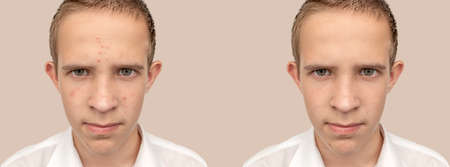 Teen boy with acne. Close-up. Facial skin treatment.の写真素材
