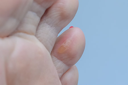 Callus on woman's toe. Woman's foot disease. close-up.