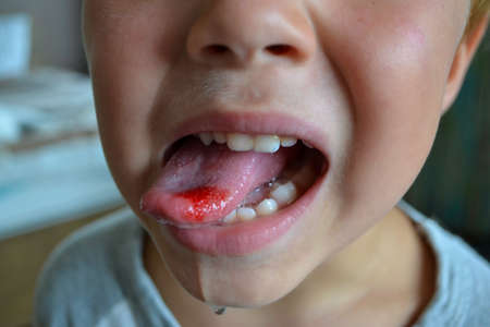 Close-up of lips, tongue, protrusion of blood. Childs bitten tongue. High quality photoの写真素材