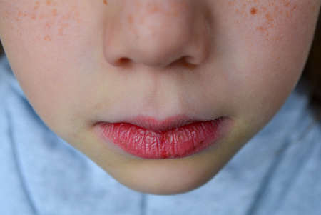 Dry and damaged lips of a girl. Close-up. Lip fissure and bleeding. Sick cracked damaged tissue. Dry lips with cracks, dry mouth, Closeup face with brittle and dry lips, dehydration High quality photoの写真素材
