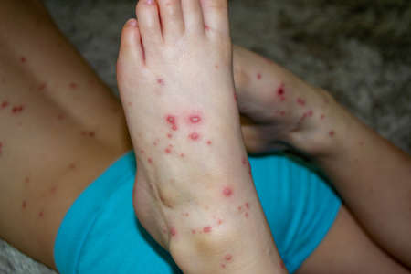 Natural vaccination. Contagious disease. Sick child with chickenpox. Varicella virus or Chickenpox...