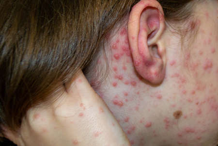 Natural vaccination. Contagious disease. Sick child with chickenpox. Varicella virus or Chickenpox...