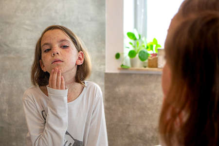 Natural vaccination. Contagious disease. Sick child with chickenpox. Varicella virus or Chickenpox bubble rash on child body and face. High quality photoの写真素材