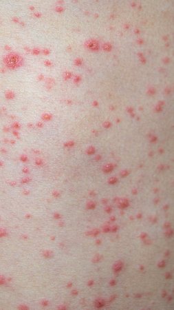 Natural vaccination. Contagious disease. Sick child with chickenpox. Varicella virus or Chickenpox bubble rash on child body and face. High quality photoの写真素材