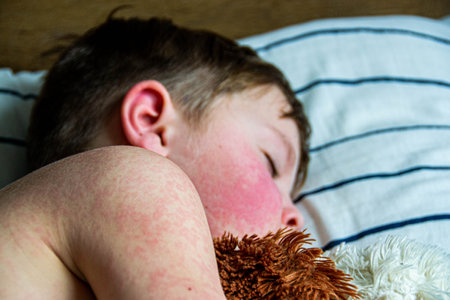 Viral disease. Measles rash on the body of the child. Allergy. A handsome boy with measles is...