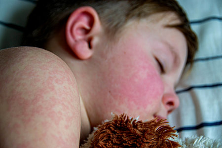 Viral disease. Measles rash on the body of the child. Allergy. A handsome boy with measles is sleeping in bed with his soft toy High quality photoの写真素材