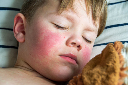 Viral disease. Measles rash on the body of the child. Allergy. A handsome boy with measles is sleeping in bed with his soft toy High quality photoの写真素材