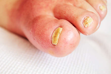 erysipelas of the legs, red rash on the legs.selectivw focusの写真素材