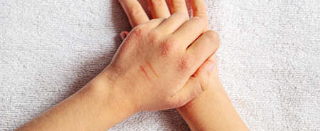 Red spots on the skin of the child's hands.children's allergy.selective focus.natureの写真素材