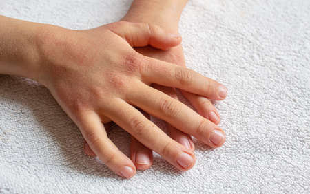 Red spots on the skin of the child's hands.children's allergy.selective focus.natureの写真素材