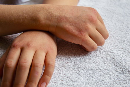 Red spots on the skin of the child's hands.children's allergy.selective focus.natureの写真素材