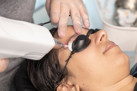 The cosmetologist makes the procedure of laser hair removal in a beauty salonの写真素材