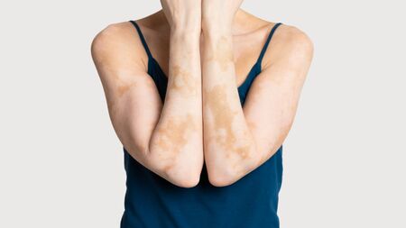 Cropped of young european woman with skin condition loss of melaninの写真素材
