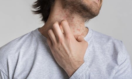 Eczema and itching concept. Red spots on skin of man, empty space, cropped