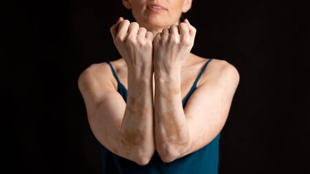 No fear concept. Girl in studio with vitiligo disease and skin troubleの写真素材