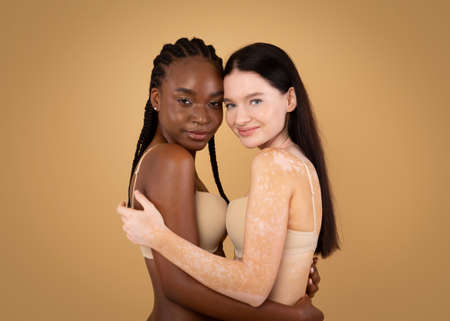 Different Beauty. Young Black Lady And Woman With Vitiligo Disorder Posing Together Over Beige...