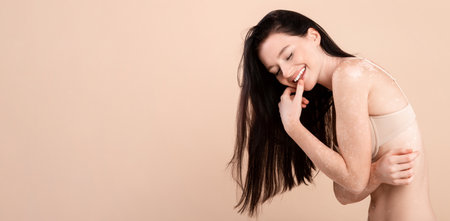 Body Acceptance. Portrait Of Happy Beautiful Lady With Vitiligo Skin Wearing Underwearの写真素材