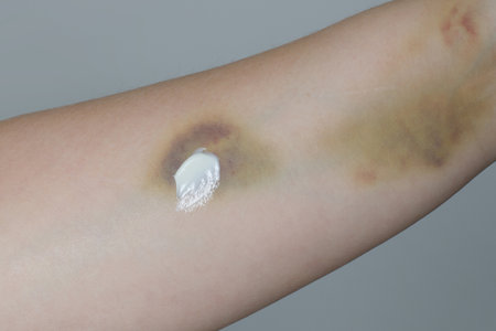 Medical ointment or cream on skin closeupの写真素材