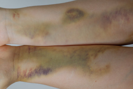 Big bruise on the woman's hands close upの写真素材