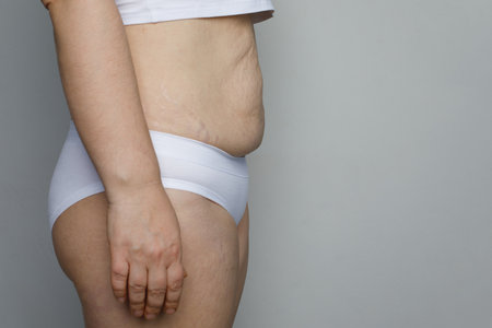 A woman waist with striae and overweight, profile close upの写真素材