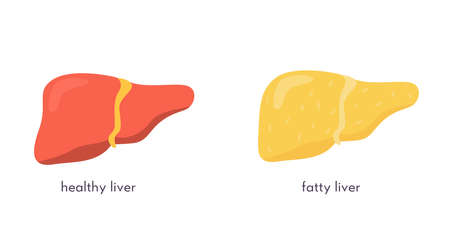 Stages of nonalcoholic liver damage. Healthy and unhealthy fatty human organ. Liver Disease. Vector illustration in flat cartoon style isolated on white.のイラスト素材