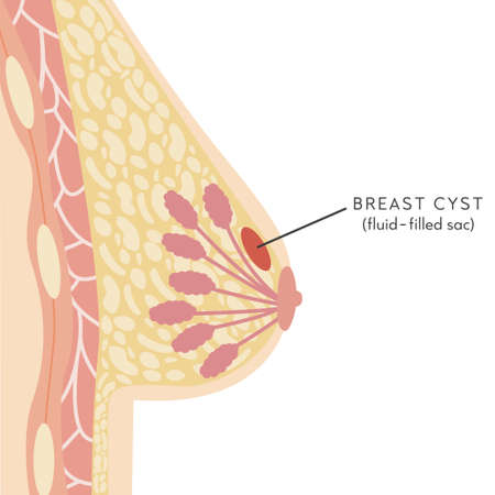 Medical Infographic Cross Section of Female Breast with Cyst. Anatomy of Woman Chest. Mammary gland. Information card with non-cancerous treatable lump. Vector illustration in flat style.のイラスト素材